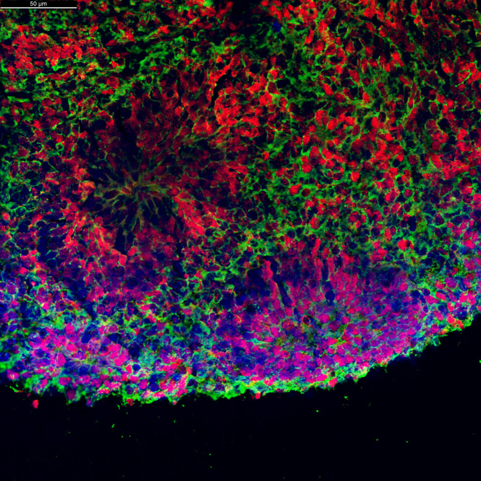 Mini-brains may enable new treatments for brain disorders like epilepsy