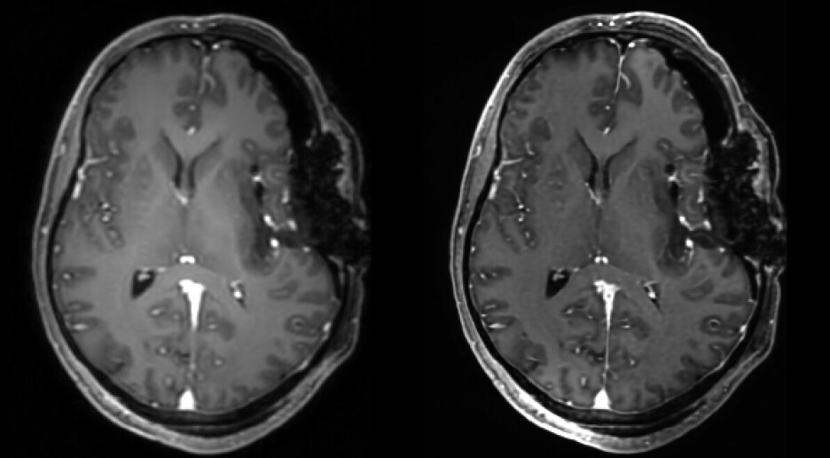 – Kunstig intelligens kan erstatta behandlarar som vi ikkje har