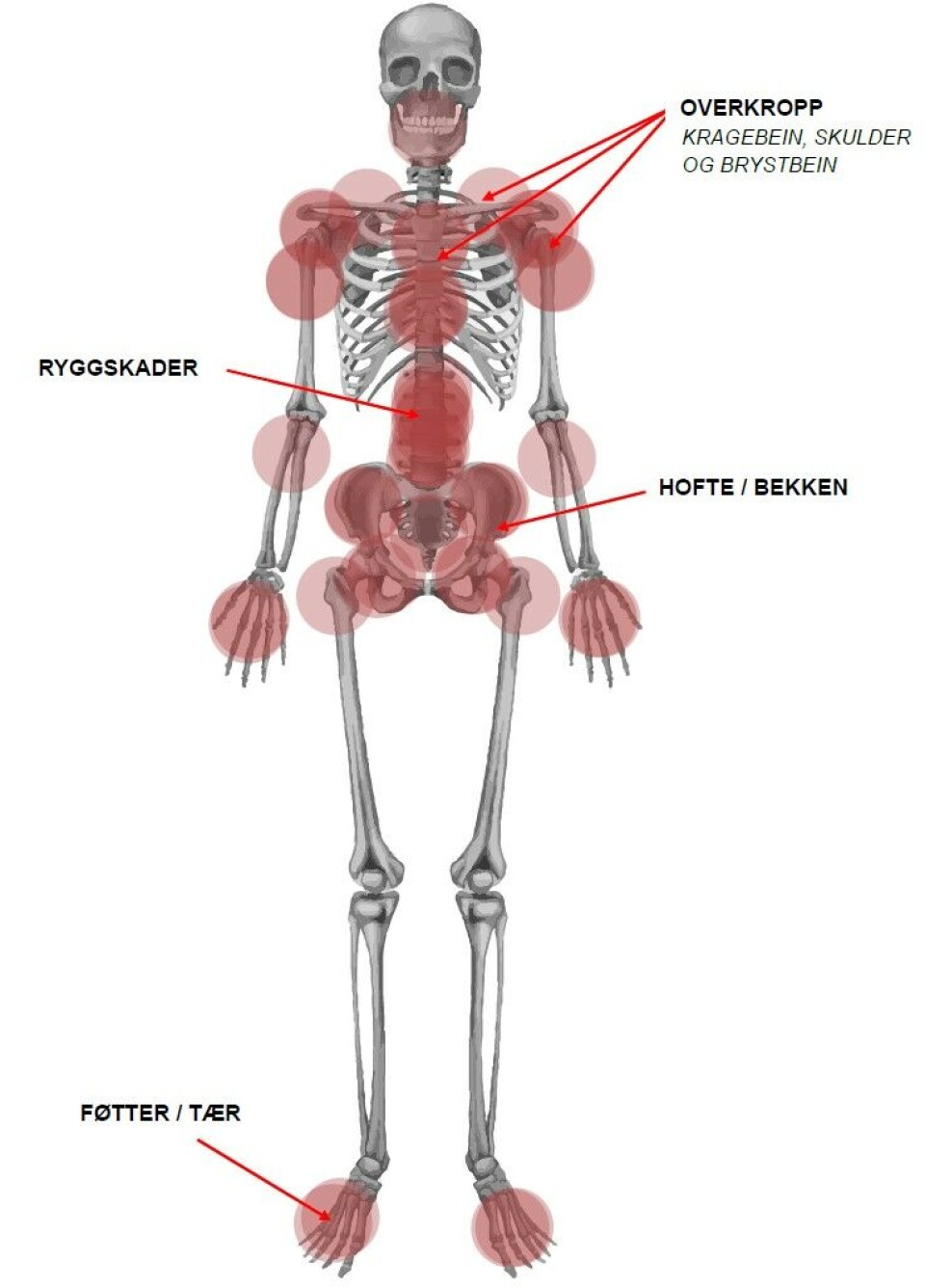 Skjelettskader. De vanligste skadene på skjelettene fra Likneset er i overkroppen, ryggraden, hoftepartiet og i hender og føtter.