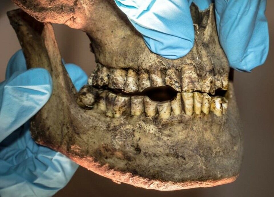 Spor av tobakksvaner. Slitasjen på flere av tennene til denne mannen er spor etter krittpipa han brukte til å røyke tobakk med.