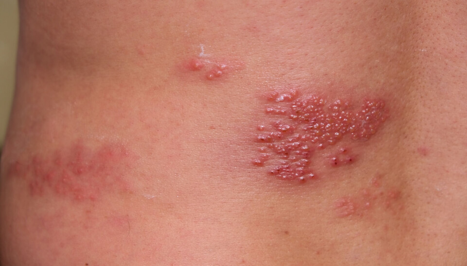 Herpes zoster, også kjent som helvetesild, gir et svært smertefullt utslett. Ifølge Folkehelseinstituttet vil rundt 20-30 prosent av de som har hatt vannkopper, få helvetesild i løpet av livet. Nærbilde av herpes zoster utslett på rygg, røde hissige flekker