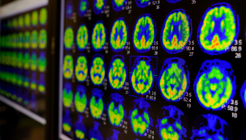 Deltakere som var i risikosonen for å utvikle Alzheimers sykdom fikk scannet hjernen med PET, en type bildeundersøkelse.