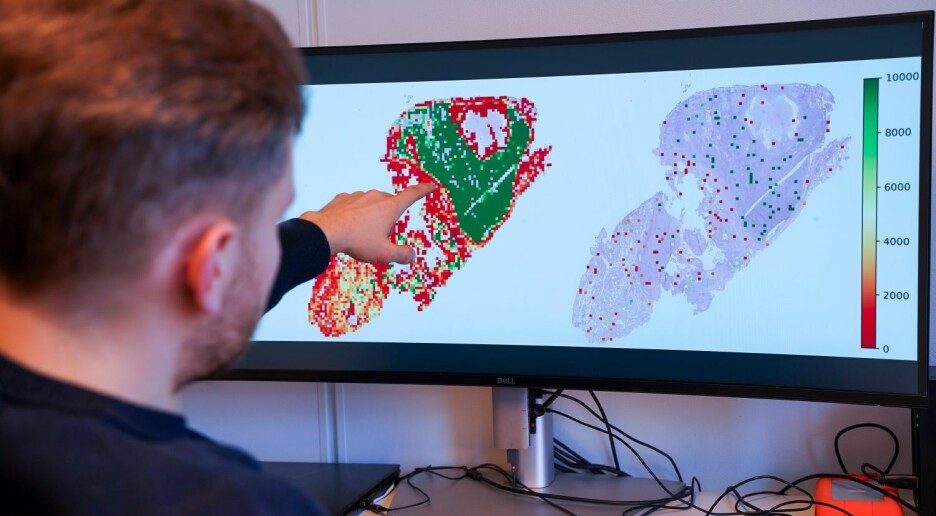 Slik kan KI bidra til raskere behandling mot lungekreft