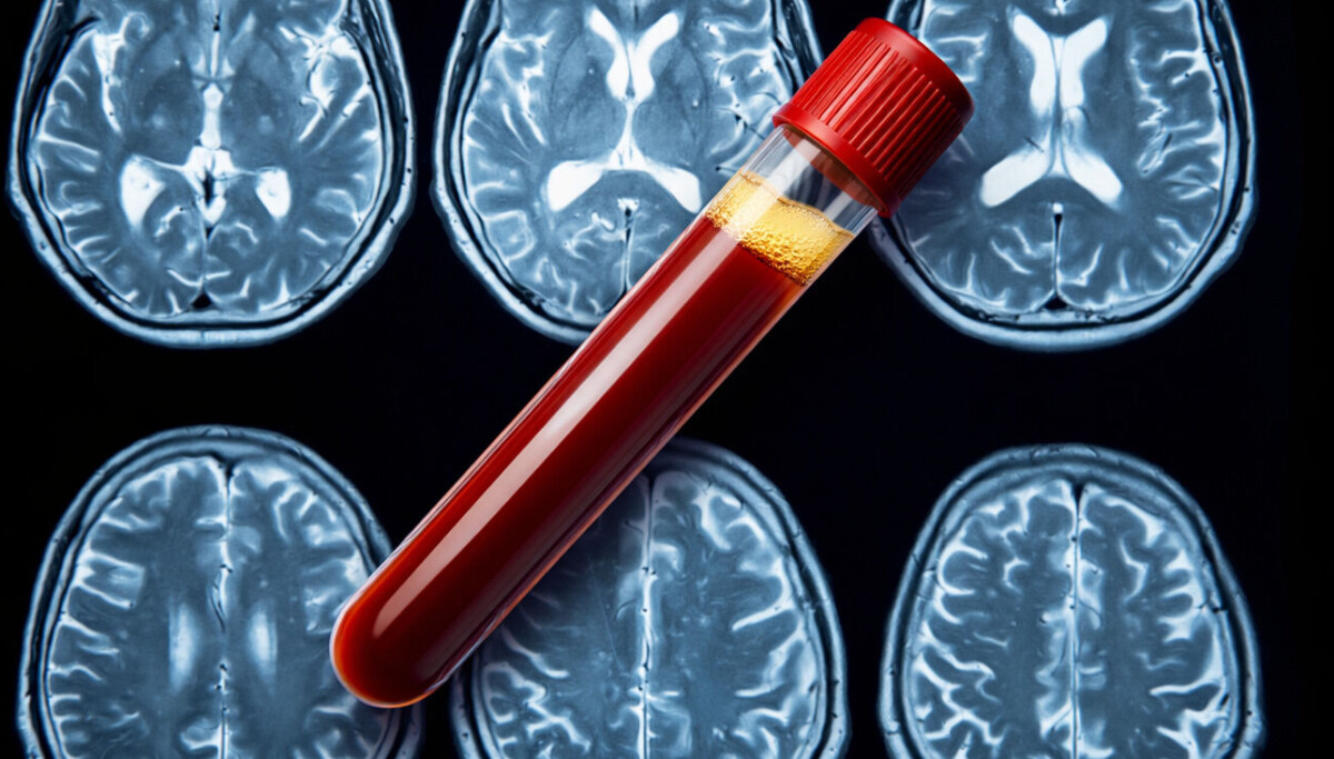 1 av 10 eldre kvalifiserer til Alzheimers-behandling, viser norsk studie som er først i verden