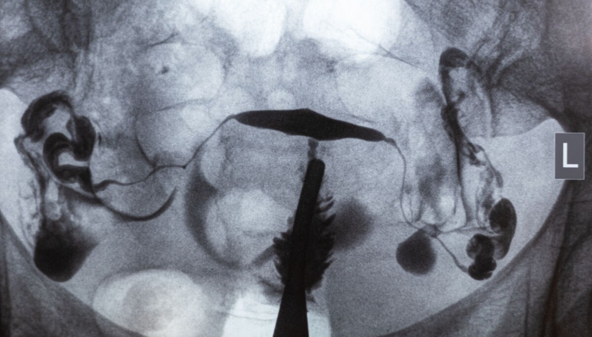 Hormoner mot overgangsalder? Det fins et oversett alternativ