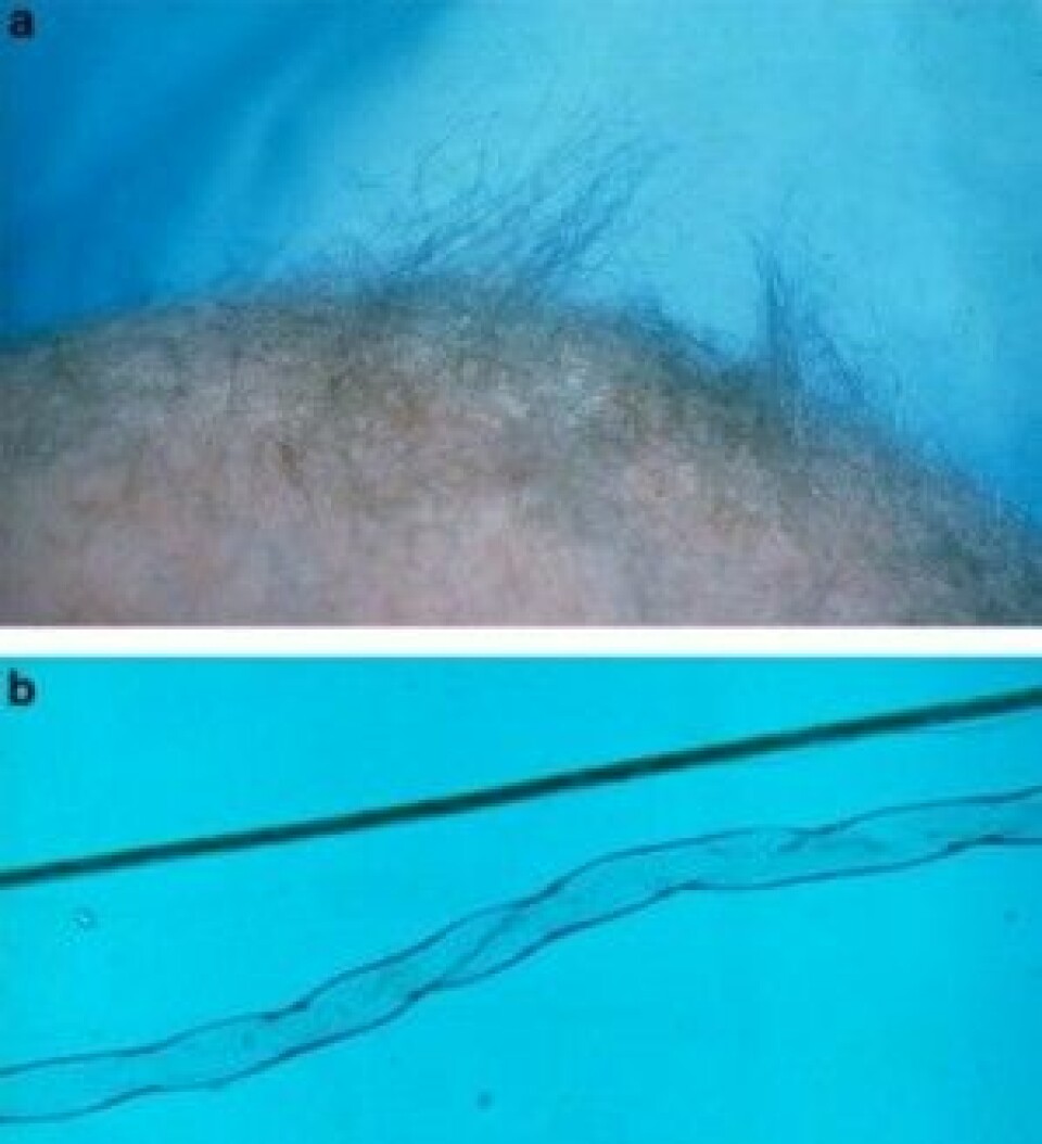 A: Håret fra en pasient med Menkes sykdom som viser klassiske tegn på sykdommen. B: 100 ganger forstørrelse av henholdsvis sunt hår (øverst) og hår rammet av «kinky hair syndrome» (nederst). (Foto: E Reske-Nielsen, Rigshospitalet Glostrup, Tümer, Z & Møller, LB, Eur J Hum Genet. 2010)
