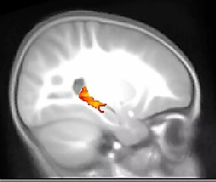 Hos mennesker har hippocampusen form som en sjøhest. Derfor heter den nettopp hippocampus, som er latinsk for sjøhest. Dette MR-bildet viser aktiviteten i hjernen til en toåring. (Foto: Simona Ghetti, UC Davis)