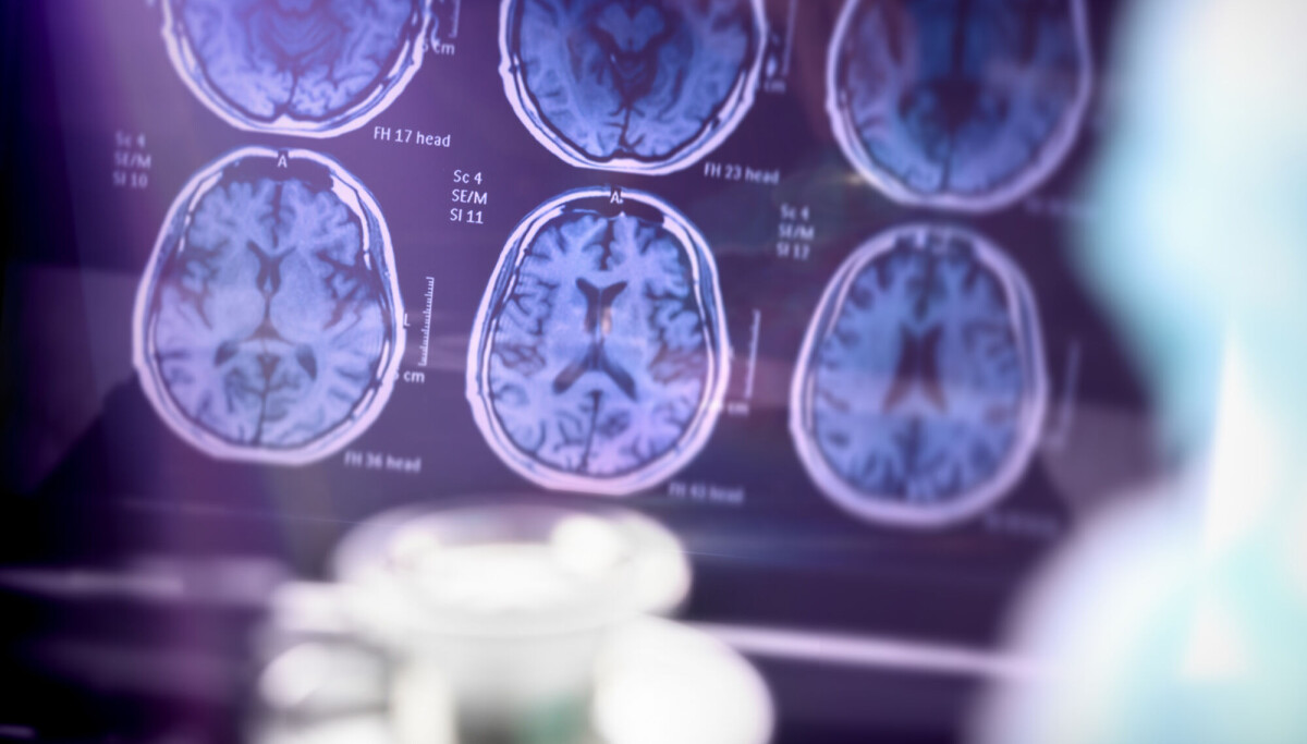 Stor studie av nye alzheimer-medisiner: Gir ingen meningsfull effekt
