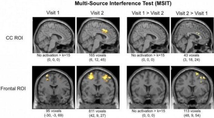 Hjerneskanninger (fMRI) viser tydelig økt aktivitet i cingulate cortex og i andre områder forrerst i hjernen etter tre måneders bruk av medisinsk cannabis. Cingulate cortex er et område som blant henger sammen med depresjon og schizofreni. (Foto: <a href="https://www.frontiersin.org/articles/10.3389/fphar.2017.00983/full">Den vitenskapelige artikkelen</a> i tidsskriftet Frontiers in Pharmacology) Hjerneskanninger (fMRI) viser tydelig økt aktivitet i cingulate cortex og i andre områder forrerst i hjernen etter tre måneders bruk av medisinsk cannabis. Cingulate cortex er et område som blant henger sammen med depresjon og schizofreni. (Foto: <a href="https://www.frontiersin.org/articles/10.3389/fphar.2017.00983/full">Den vitenskapelige artikkelen</a> i tidsskriftet Frontiers in Pharmacology)