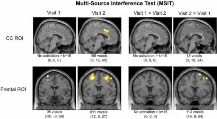 Hjerneskanninger (fMRI) viser tydelig økt aktivitet i cingulate cortex og i andre områder forrerst i hjernen etter tre måneders bruk av medisinsk cannabis. Cingulate cortex er et område som blant henger sammen med depresjon og schizofreni. (Foto: <a href="https://www.frontiersin.org/articles/10.3389/fphar.2017.00983/full">Den vitenskapelige artikkelen</a> i tidsskriftet Frontiers in Pharmacology)