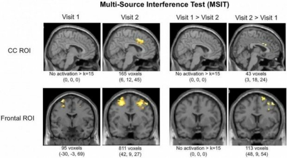 Hjerneskanninger (fMRI) viser tydelig økt aktivitet i cingulate cortex og i andre områder forrerst i hjernen etter tre måneders bruk av medisinsk cannabis. Cingulate cortex er et område som blant henger sammen med depresjon og schizofreni. (Foto: Den vitenskapelige artikkelen i tidsskriftet Frontiers in Pharmacology)