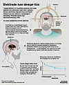 Infografikk om elektrodebehandling mot tics med hodeskisser, pilforklaringer og diagram.
