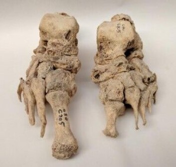 Forskerne har hentet ut DNA fra knokler fra 69 pasienter med spedalskhet. Det blir sammenlignet med DNA fra 152 tilfeldig utvalgte skjeletter (kontroller) fra samme periode. Det er ifølge Ben Krause-Kyora første gang man utfører denne typen studie (case-kontroll-studie) på gammelt DNA (aDNA). (Foto: Dorthe Pedersen) Forskerne har hentet ut DNA fra knokler fra 69 pasienter med spedalskhet. Det blir sammenlignet med DNA fra 152 tilfeldig utvalgte skjeletter (kontroller) fra samme periode. Det er ifølge Ben Krause-Kyora første gang man utfører denne typen studie (case-kontroll-studie) på gammelt DNA (aDNA). (Foto: Dorthe Pedersen)