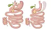 Illustrasjon som viser to medisinske diagrammer av magesekk og tarm ved gastric bypass og gastric sleeve.