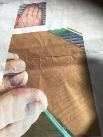 Et foto fra innleggelsesprotokollen viser at tærne til kvinnen var blå da hun ble innlagt. Fingrene var vekslende hvite og rødspraglete. Smertene i kroppen var så sterke at hun ikke klarte berøring eller å ha ha dynen over seg til tider. (Foto: Siw Ellen Jakobsen) Et foto fra innleggelsesprotokollen viser at tærne til kvinnen var blå da hun ble innlagt. Fingrene var vekslende hvite og rødspraglete. Smertene i kroppen var så sterke at hun ikke klarte berøring eller å ha ha dynen over seg til tider. (Foto: Siw Ellen Jakobsen)