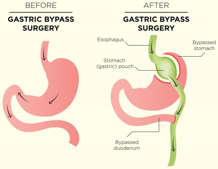 Når du gjennomgår en gastrisk bypass, som også kalles bariatrisk kirurgi, reduserer du størrelsen på magesekken drastisk. Kirurgen lager en liten lomme på toppen av magesekken og kobler denne sammen med tynntarmen din. Resten av magesekken sjaltes ut. Derfor rommer magesekken din etter betydelig mindre mat etter inngrepet. Maten som tidligere passerte gjennom magesekken og tolvfingertarmen, passerer nå forbi («bypass») denne delen av fordøyelseskanalen, skriver nettsiden NHI.no. (Illustrasjon: bearsky23 / Shutterstock / NTB scanpix) Når du gjennomgår en gastrisk bypass, som også kalles bariatrisk kirurgi, reduserer du størrelsen på magesekken drastisk. Kirurgen lager en liten lomme på toppen av magesekken og kobler denne sammen med tynntarmen din. Resten av magesekken sjaltes ut. Derfor rommer magesekken din etter betydelig mindre mat etter inngrepet. Maten som tidligere passerte gjennom magesekken og tolvfingertarmen, passerer nå forbi («bypass») denne delen av fordøyelseskanalen, skriver nettsiden NHI.no. (Illustrasjon: bearsky23 / Shutterstock / NTB scanpix)