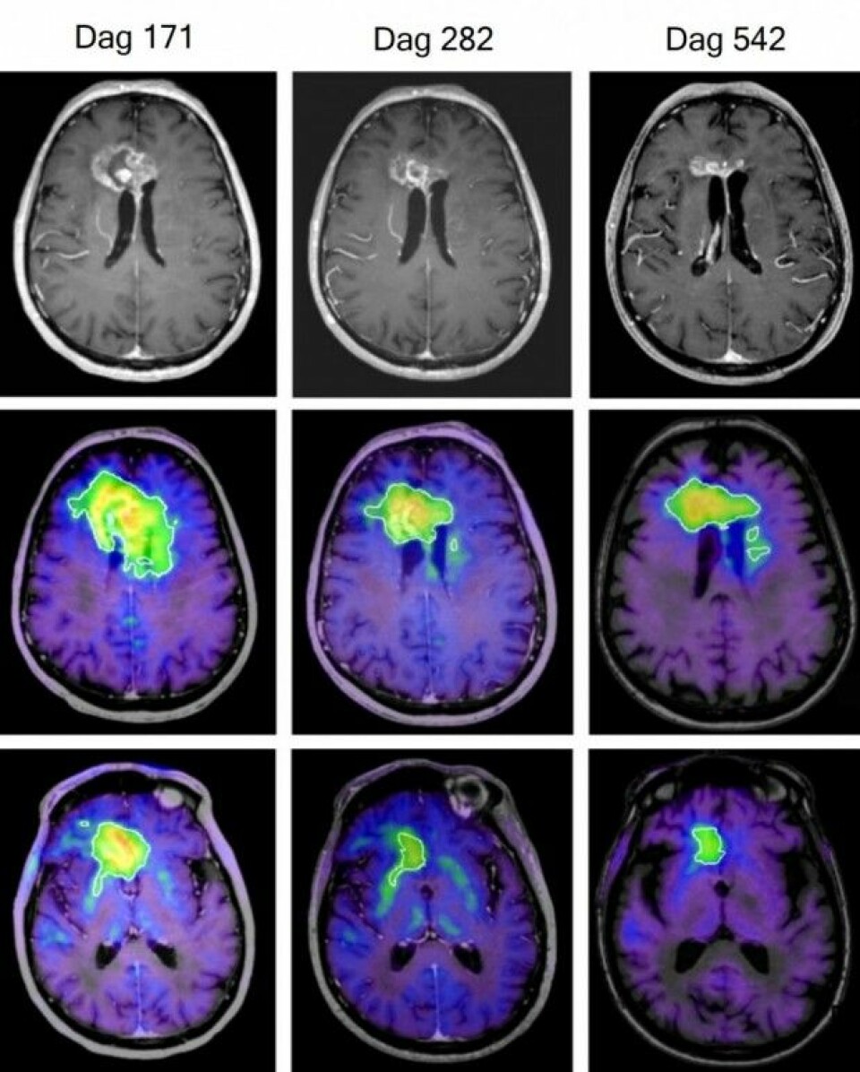 Under forsøket ble størrelsen på hjernesvulsten til en 76-åring mer enn halvert, viser disse hjerneskanningene tatt etter henholdsvis 171, 282 og 542 dager. De øverste bildene er fra MRI-skanninger, mens de fargede er fra FET-PET-skanninger. (Foto: Kirkin et al., Nature Communications)