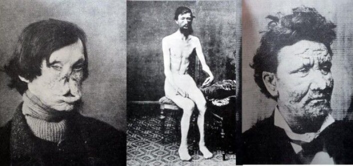 I Norge fortsatte spedalskhet å herje langt ut på 1900-tallet. Den norske legen Gerhard Armauer Hansen oppdaget at spedalskhet skyldes en bakterieinfeksjon. Bildene er fra Armauer Hansens lærebok fra 1895. (Foto lånt ut av Jesper From) I Norge fortsatte spedalskhet å herje langt ut på 1900-tallet. Den norske legen Gerhard Armauer Hansen oppdaget at spedalskhet skyldes en bakterieinfeksjon. Bildene er fra Armauer Hansens lærebok fra 1895. (Foto lånt ut av Jesper From)