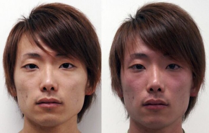 Asian flush i full blomst. (Foto: PLoS Medicine (2009)) Asian flush i full blomst. (Foto: PLoS Medicine (2009))