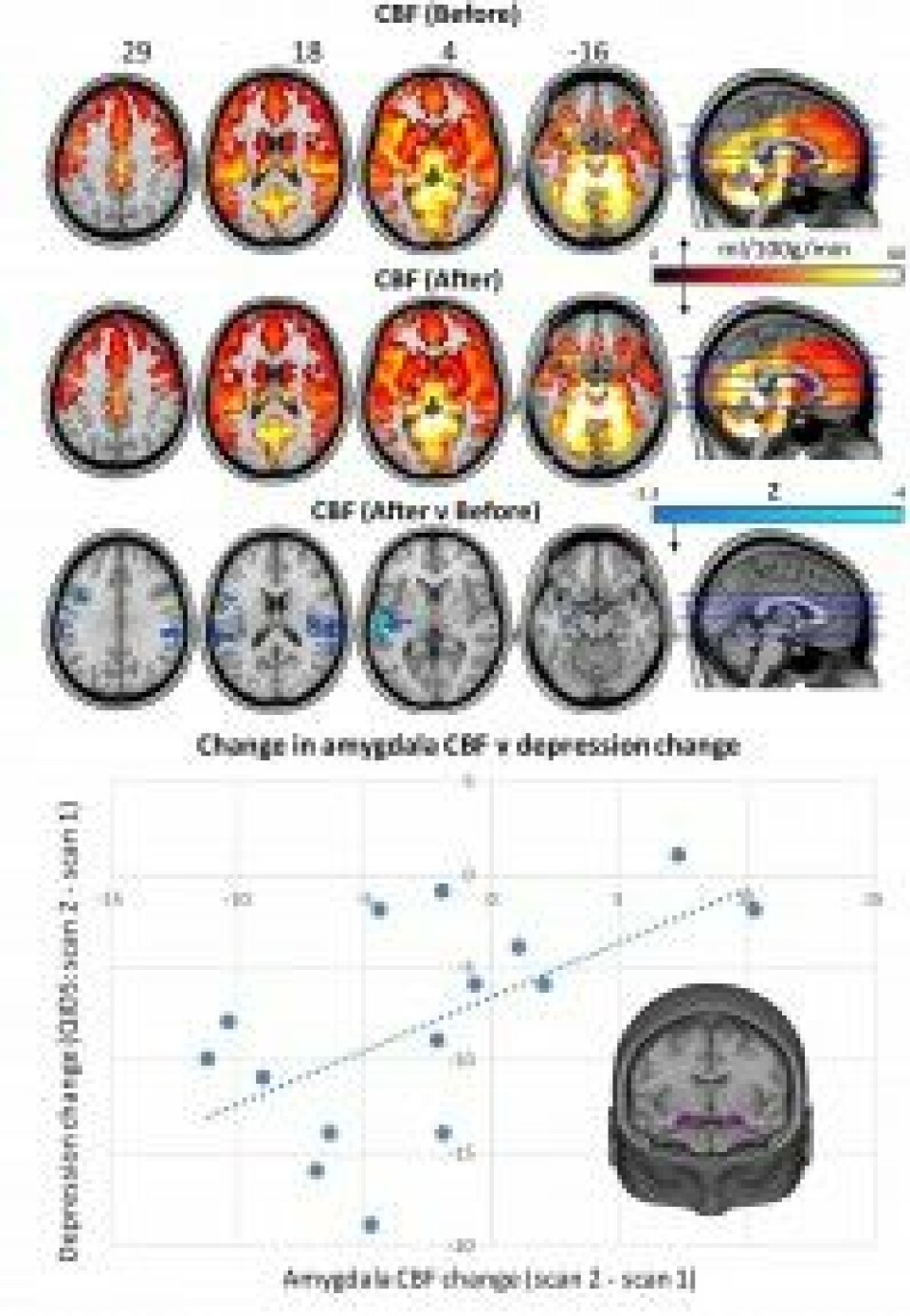 Bilder over blodgjennomstrømming i hjernen før behandling og etter en dags behandling. Diagrammet under viser endringer i hjernens amygdala der primitive følelser behandles og endringer i symptomer på depresjon. (Foto: Scientific Reports 7/2017)