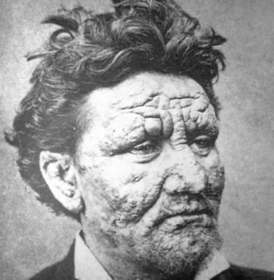 En ung mann med spedalskhet på slutten av 1800-tallet. (Bilde: Pierre Arents)