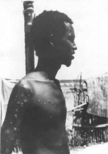 Ali Maow Maalin fra Merka, Somalia, siste menneske med naturlig koppeinfeksjon. Du kan se koppearrene på kroppen hans. (Foto: CDC / Verdens helseorganisasjon) Ali Maow Maalin fra Merka, Somalia, siste menneske med naturlig koppeinfeksjon. Du kan se koppearrene på kroppen hans. (Foto: CDC / Verdens helseorganisasjon)