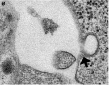 Denne cellen som før har vært en hudcelle, slipper ut insulin. Den har blitt omprogrammert via stamcellebehandling til å produsere insulin.<br>(Foto: Vethe et al, Scientific Report) Denne cellen som før har vært en hudcelle, slipper ut insulin. Den har blitt omprogrammert via stamcellebehandling til å produsere insulin.<br>(Foto: Vethe et al, Scientific Report)