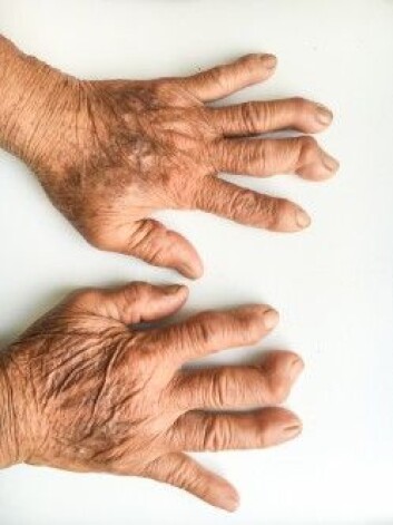 Leddgikt kan deformere både fingre og tær og gjøre det vanskeligere å bevege seg. (Foto: Shutterstock/NTB scanpix) Leddgikt kan deformere både fingre og tær og gjøre det vanskeligere å bevege seg. (Foto: Shutterstock/NTB scanpix)