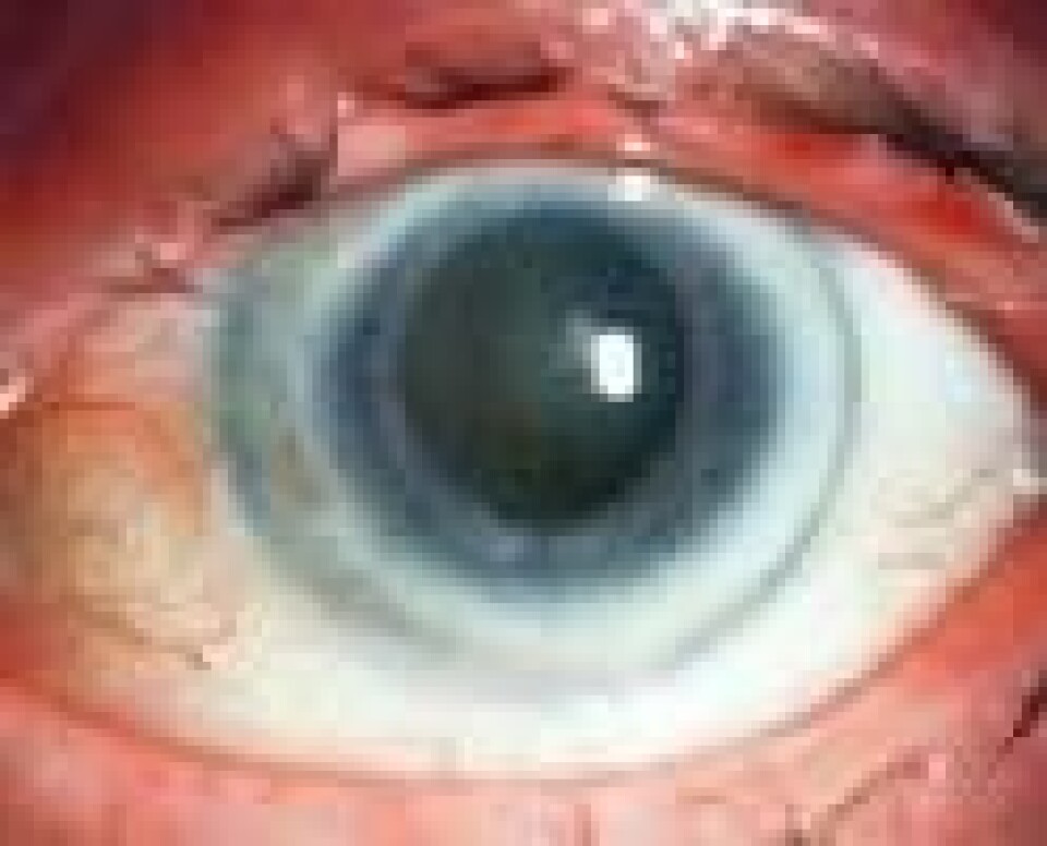 Forskerne fant at de som hadde arcus senilis, som er en ring rundt pupillen, hadde økt dødelighet i forhold til andre. (Foto: The free dictionary)