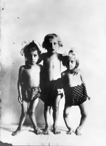 Dette bildet er tatt i Wien mellom år 1920 og 1930 og viser tre barn med ulike stadier av rakitt. (Foto: ukjent / Wellcome Library, London / <a href="https://creativecommons.org/licenses/by/4.0/">CC BY SA 4.0</a>)