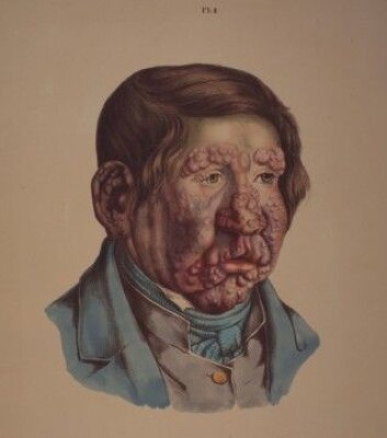 Illustrasjon fra J. L. Lostings lepraatlas. En 13 år gammel gut med fullt utviklede knuter i ansiktet. Han ble rammet av lepra som seksåring. (Gjengitt med tillatelse fra Lepramuseet St. Jørgens Hospital/Bymuseet i Bergen) Illustrasjon fra J. L. Lostings lepraatlas. En 13 år gammel gut med fullt utviklede knuter i ansiktet. Han ble rammet av lepra som seksåring. (Gjengitt med tillatelse fra Lepramuseet St. Jørgens Hospital/Bymuseet i Bergen)