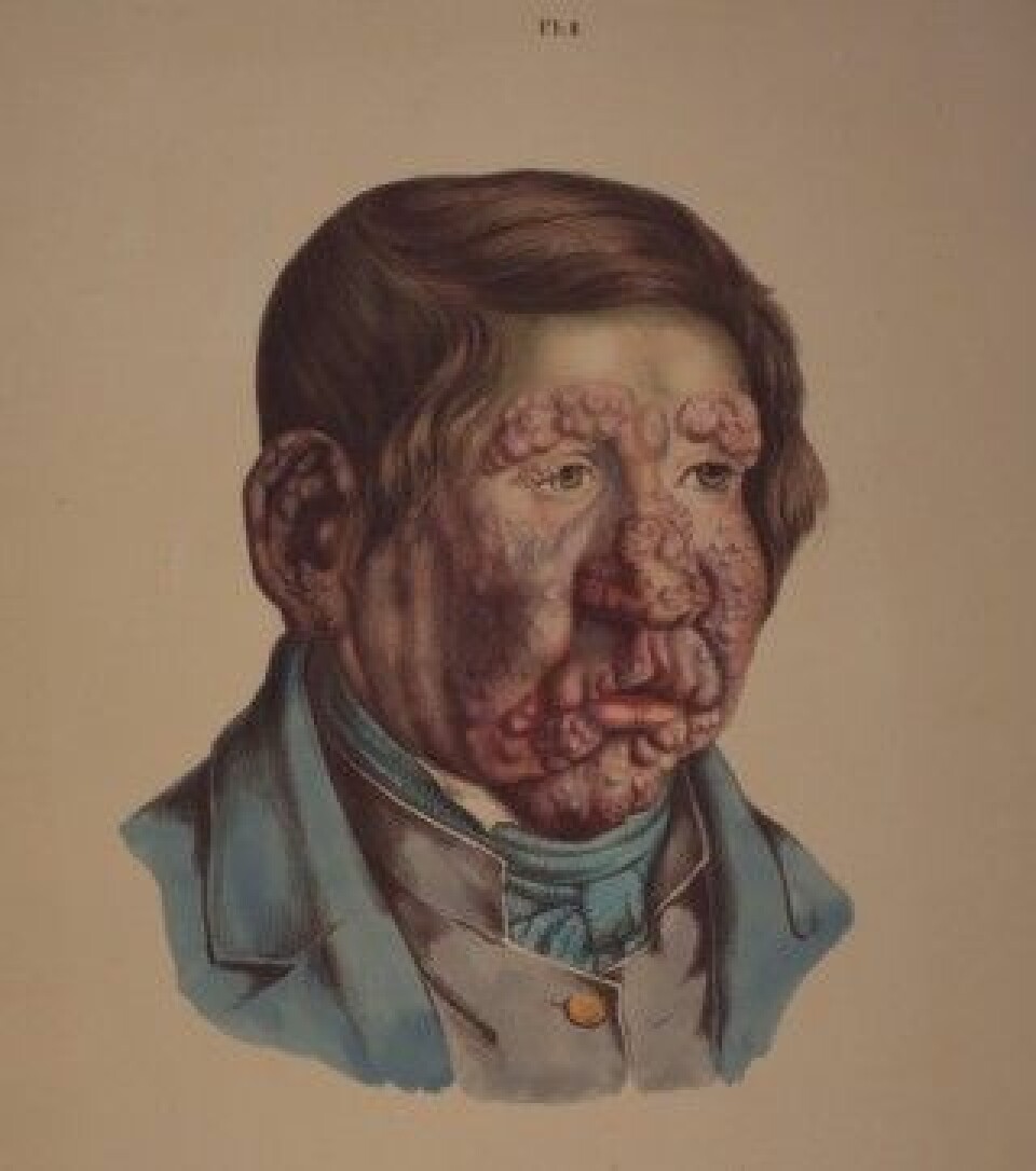 Illustrasjon fra J. L. Lostings lepraatlas. En 13 år gammel gut med fullt utviklede knuter i ansiktet. Han ble rammet av lepra som seksåring. (Gjengitt med tillatelse fra Lepramuseet St. Jørgens Hospital/Bymuseet i Bergen)