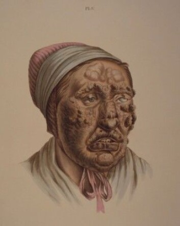 Illustrasjon fra J.L. Lostings lepraatlas. En 28 år gammel kvinne med knuter som har fått gråbrune skorper. (Gjengitt med tillatelse fra Lepramuseet St. Jørgens Hospital/Bymuseet i Bergen) Illustrasjon fra J.L. Lostings lepraatlas. En 28 år gammel kvinne med knuter som har fått gråbrune skorper. (Gjengitt med tillatelse fra Lepramuseet St. Jørgens Hospital/Bymuseet i Bergen)