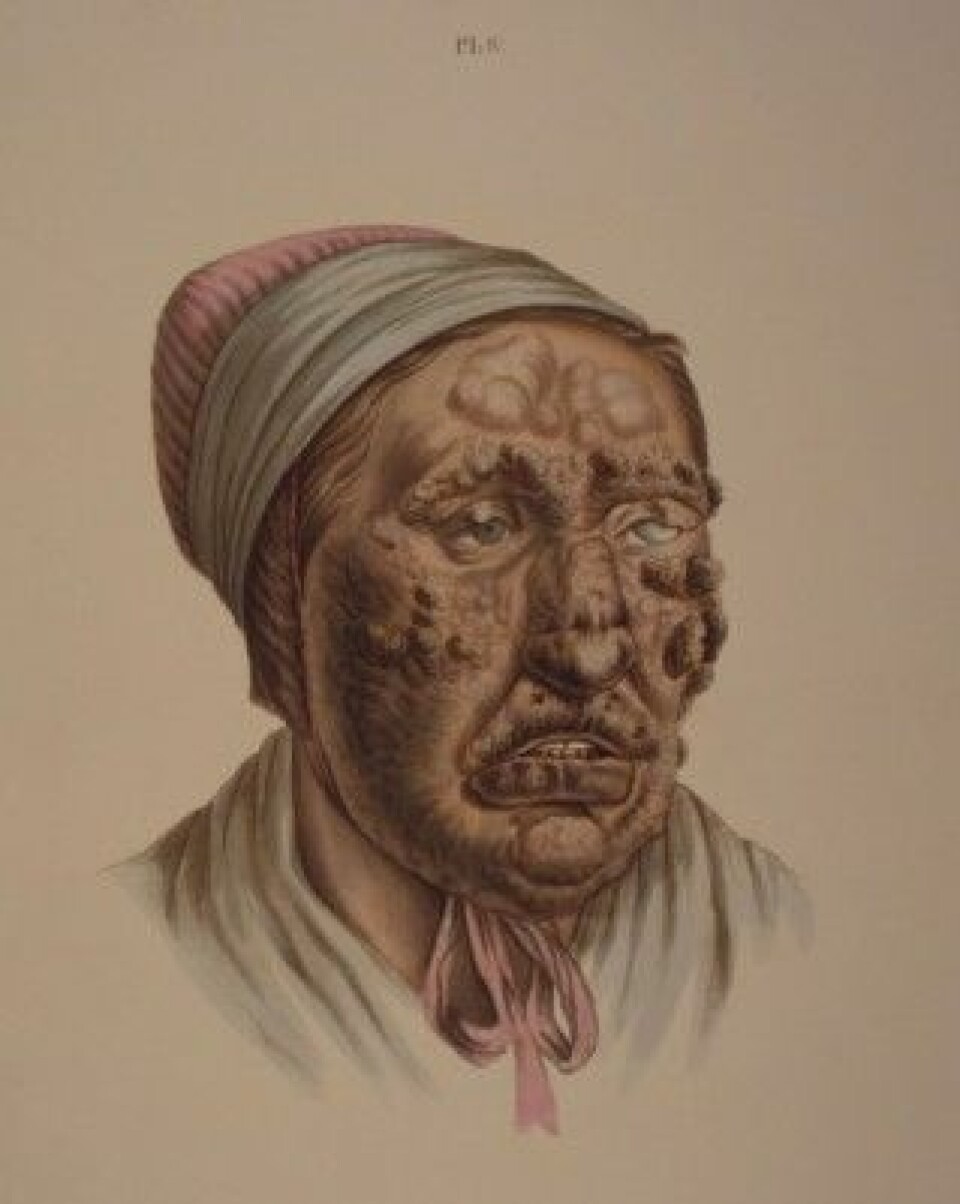 Illustrasjon fra J.L. Lostings lepraatlas. En 28 år gammel kvinne med knuter som har fått gråbrune skorper. (Gjengitt med tillatelse fra Lepramuseet St. Jørgens Hospital/Bymuseet i Bergen)