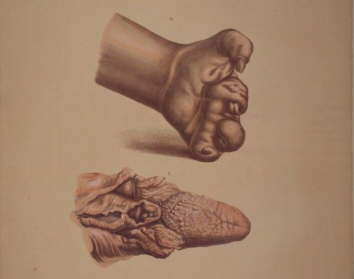 Illustrasjon fra J.L. Lostings lepraatlas. En deformert hånd som følge av glatt lepra, mens vi nedenfor ser en tunge og deler av strupen, angrepet av knutete lepra. (Foto er gjengitt med tillatelse fra Lepramuseet St. Jørgens Hospital/Bymuseet i Bergen) Illustrasjon fra J.L. Lostings lepraatlas. En deformert hånd som følge av glatt lepra, mens vi nedenfor ser en tunge og deler av strupen, angrepet av knutete lepra. (Foto er gjengitt med tillatelse fra Lepramuseet St. Jørgens Hospital/Bymuseet i Bergen)