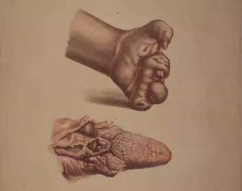 Illustrasjon fra J.L. Lostings lepraatlas. En deformert hånd som følge av glatt lepra, mens vi nedenfor ser en tunge og deler av strupen, angrepet av knutete lepra. (Foto er gjengitt med tillatelse fra Lepramuseet St. Jørgens Hospital/Bymuseet i Bergen)